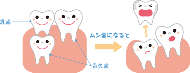 ムシ歯になると